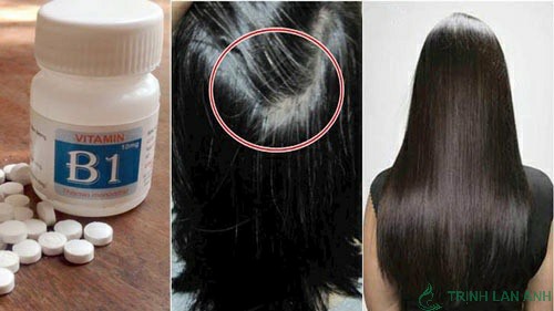 Vitamin B1 hỗ trợ điều trị rụng tóc hiệu quả