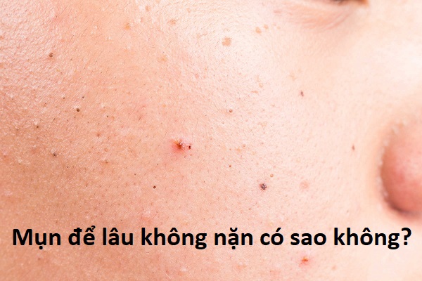 Mụn để lâu không nặn có sao không