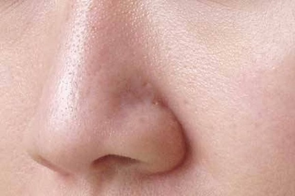 Vì sao mũi bị nhờn?