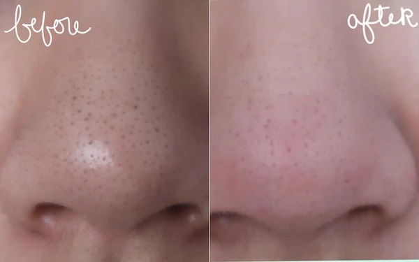 Cách khắc phục mũi nhờn