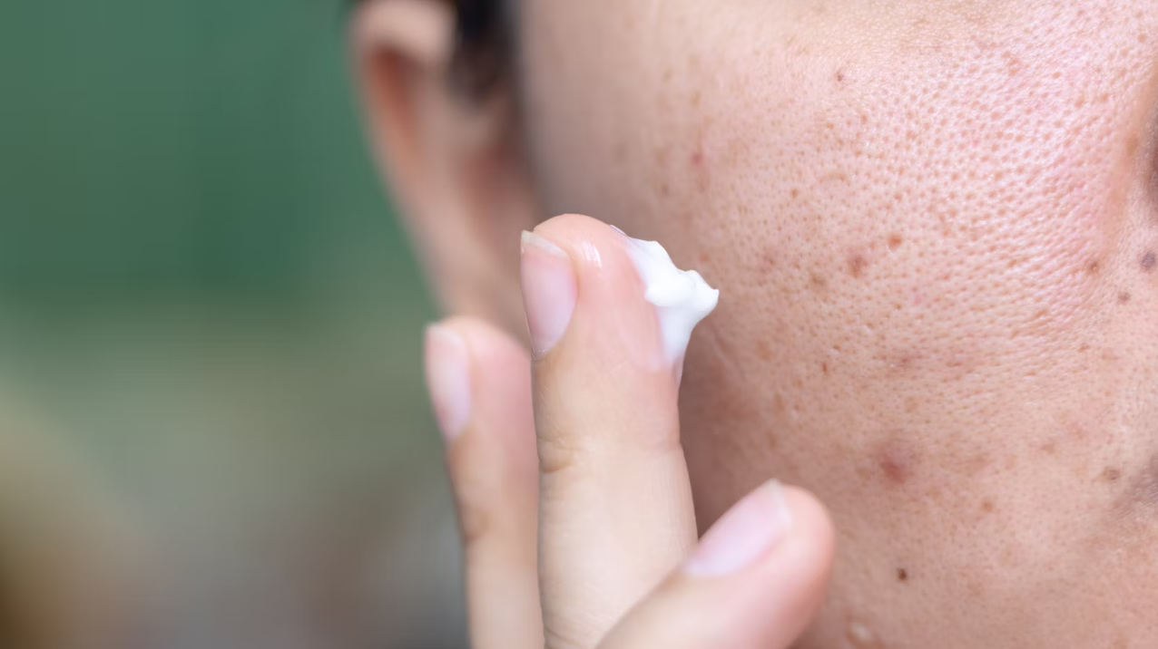 Cách chăm sóc da sau khi nặn mụn