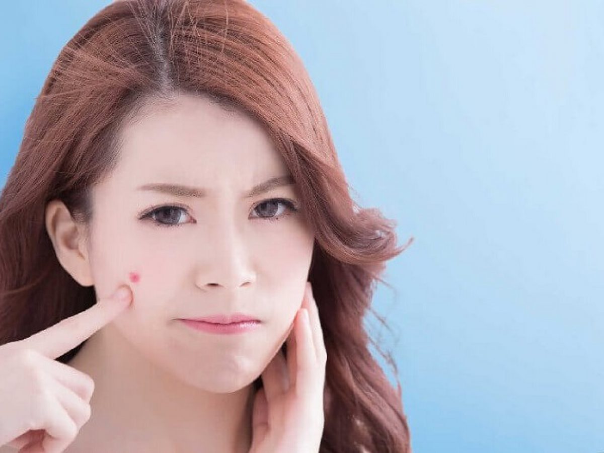 Sau khi nặn mụn nên kiêng ăn bao lâu? - Bạn có biết?