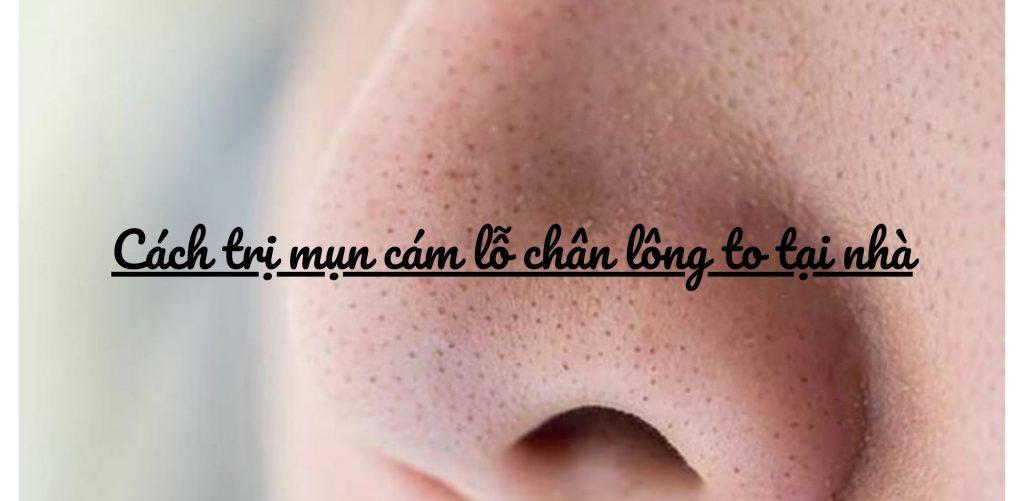 Cách trị mụn cám lỗ chân lông to tại nhà