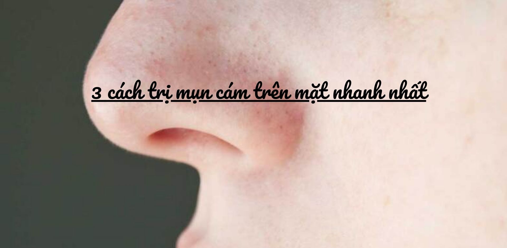 3 cách trị mụn cám trên mặt nhanh nhất