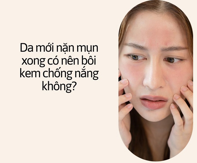 mới nặn mụn xong có nên bôi kem chống nắng không