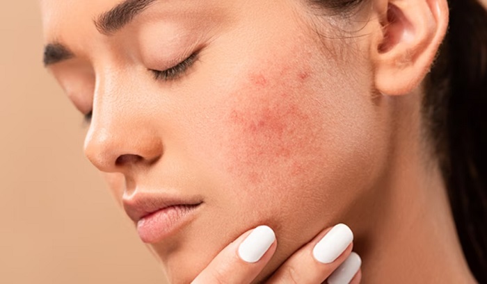 Làn da bị kích ứng do kem chống nắng
