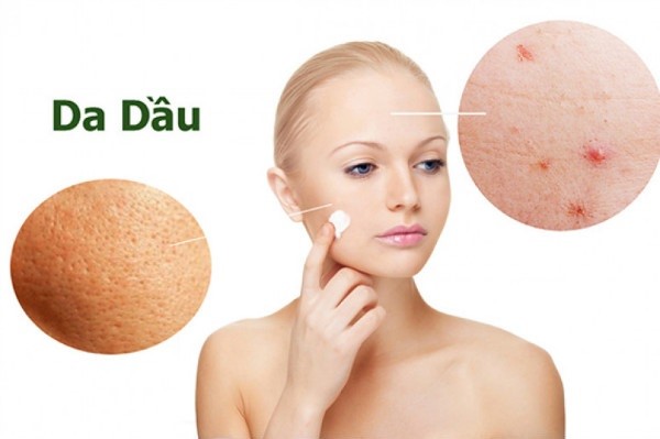 Da dầu mụn khiến phái đẹp mất tự tin