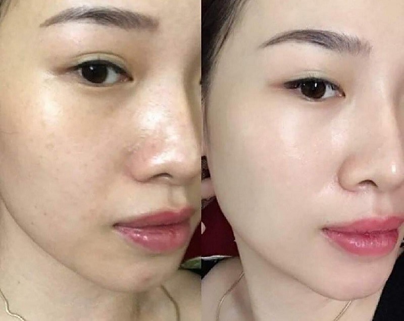 Lợi ích của kem chống nắng