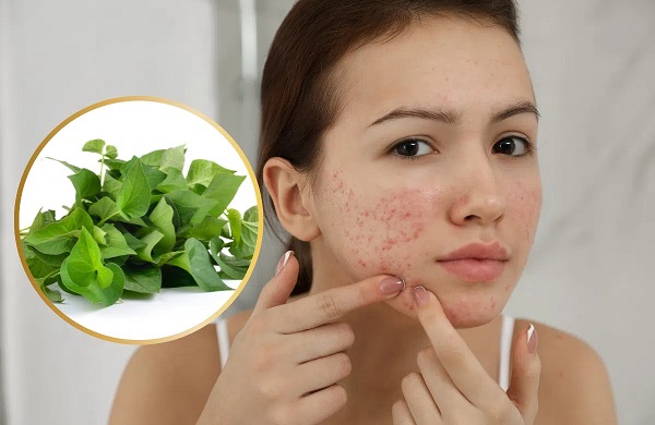 Đắp rau diếp cá trị mụn có tốt không