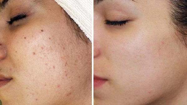 Đẩy mụn là cơ chế làm sạch mụn hiệu quả