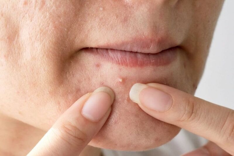 Mụn đầu trắng có nên nặn không?