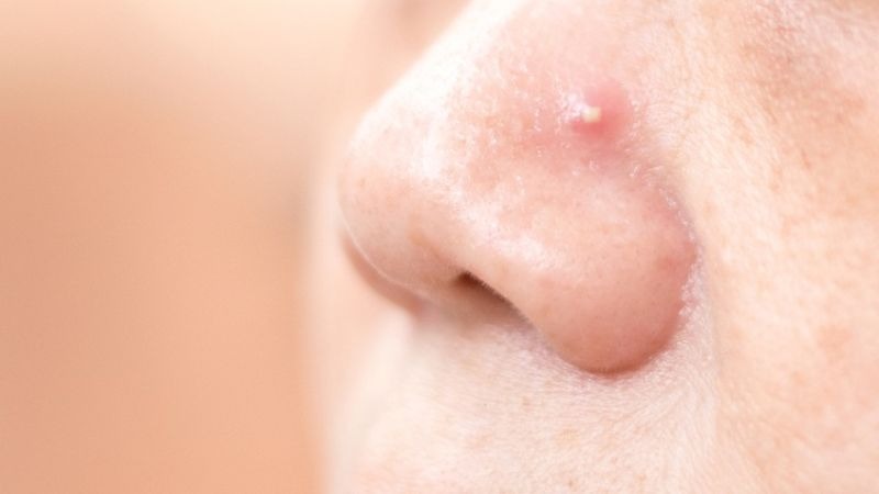Xử lý mụn đầu trắng đúng cách