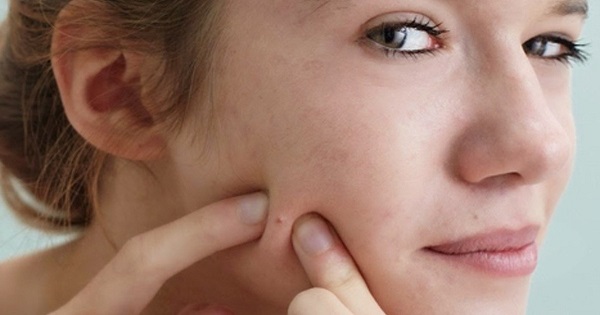 Nặn mụn là thói quen của nhiều người