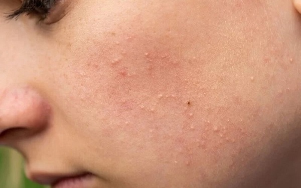 Sử dụng Differin đúng cách