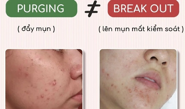 Phân biệt đẩy mụn và kích ứng