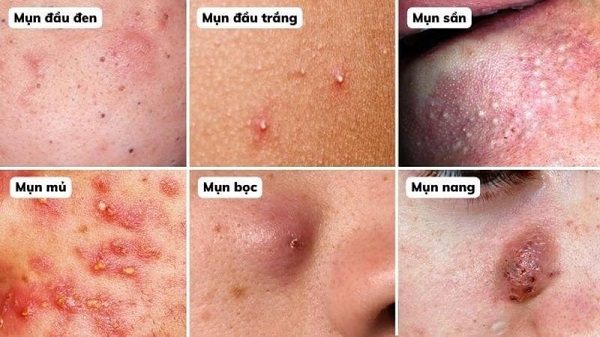Lấy nhân mụn là thói quen của nhiều người