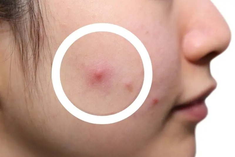yếu tố ảnh hưởng đến khả năng tự xẹp của mụn bọc không đầu