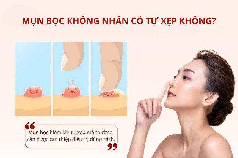 Mụn bọc không đầu có tự xẹp không?