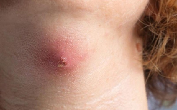 Trường hợp không nên nặn mụn đinh râu