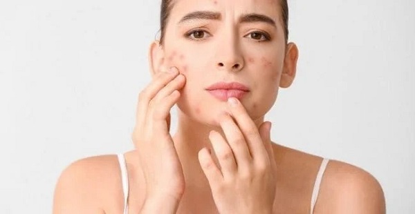 Mụn đinh râu có thể tự hết