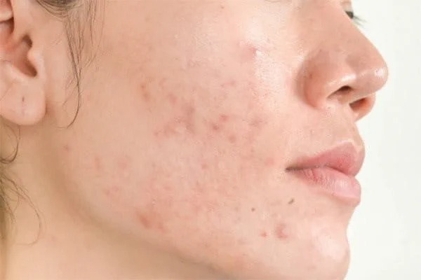 Dấu hiệu mụn kích ứng