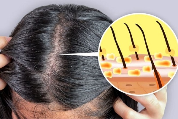 Cần giữ da dầu sạch sẽ
