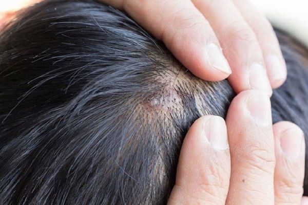 Mụn mọc trên đầu do nhiều nguyên nhân