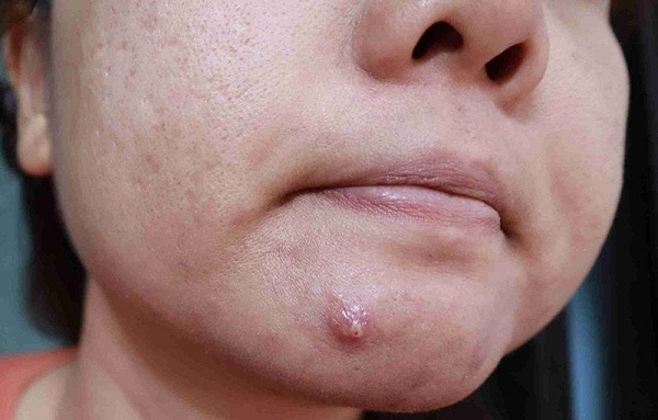 Nặn mụn đúng cách