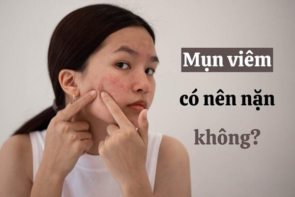 Mụn viêm có nên nặn không