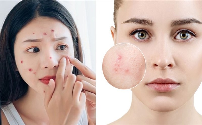 Giấc ngủ có liên quan đến mụn