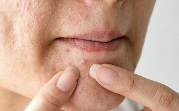 Có thể nặn mụn khi mụn đã chín