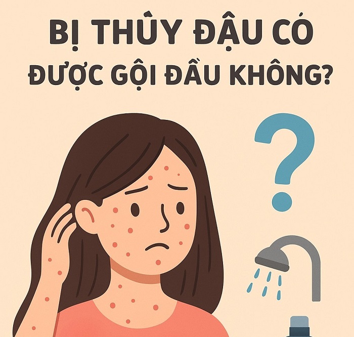 Bị thuỷ đậu có được gội đầu không