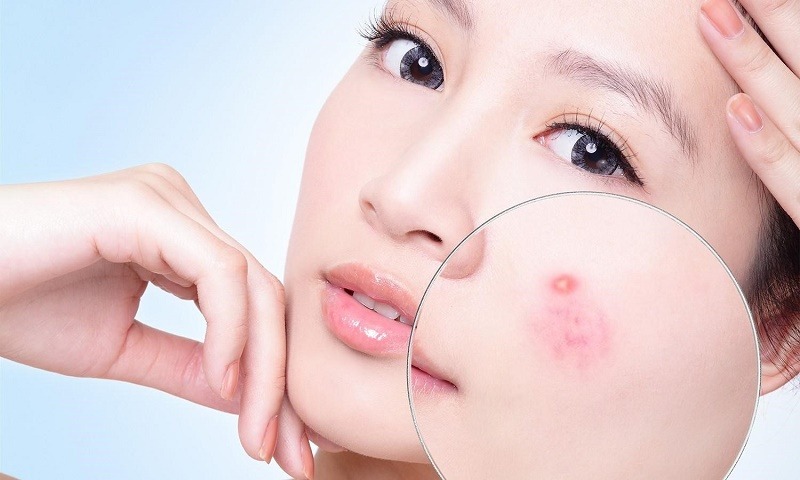 Người không có mụn cũng có thể bị mụn