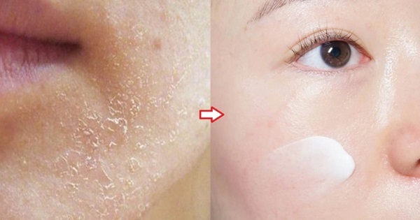 Dưỡng ẩm cho da khô đúng cách