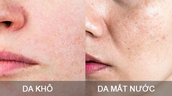 Phân biệt da khô và da mất nước
