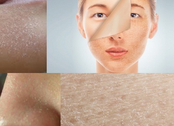 Nguyên nhân khiến da khô sần và ngứa