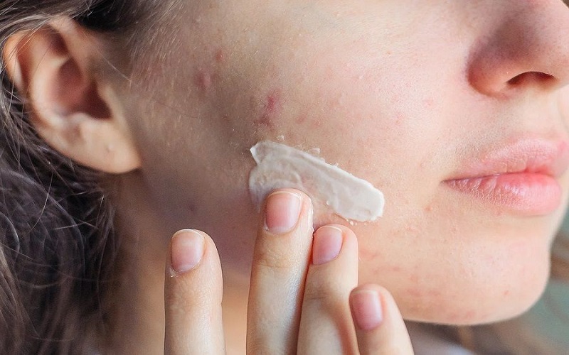 Skincare đúng cách sau khi nặn mụn
