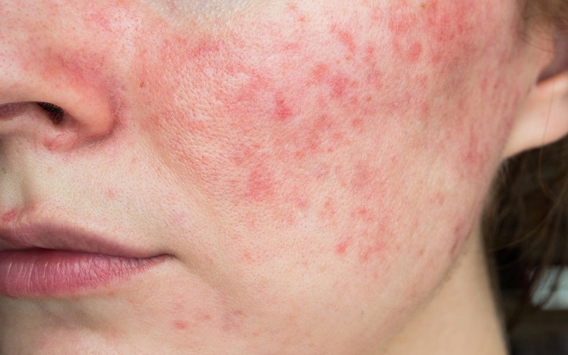 Da bị bào mòn trở nên nhạy cảm hơn