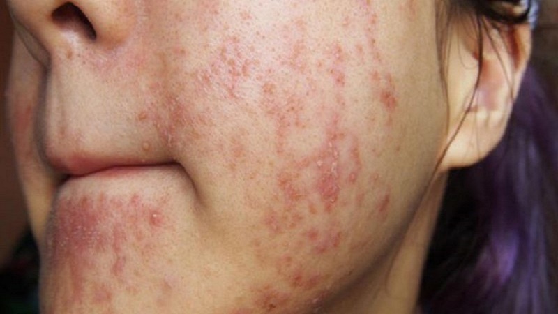 Sử dụng mỹ phẩm không rõ nguồn gốc khiến da bị nhiễm corticoid