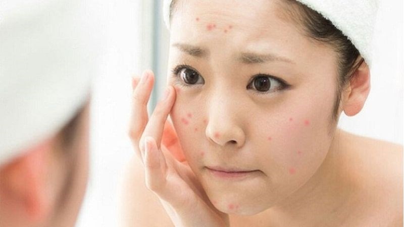 Làm sạch da sai cách dễ gây mụn và giảm hiệu quả dưỡng da