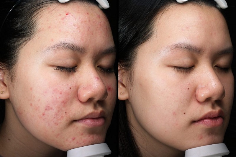 Da nhiễm corticoid cần thời gian và sự kiên nhẫn để phục hồi