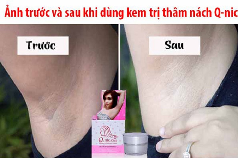 Tình trạng vùng da được cải thiện sau khi dùng trị thâm nách Q-Nic Care