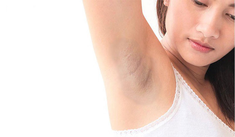 Vùng da dưới cánh tay sẫm màu cần sử dụng kem trị thâm nách tốt
