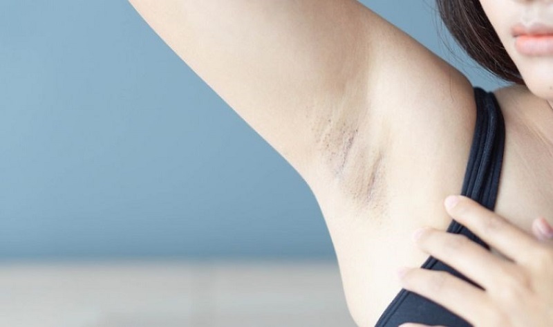 Thay đổi nội tiết tố trong thai kỳ là một trong những nguyên nhân gây thâm nách