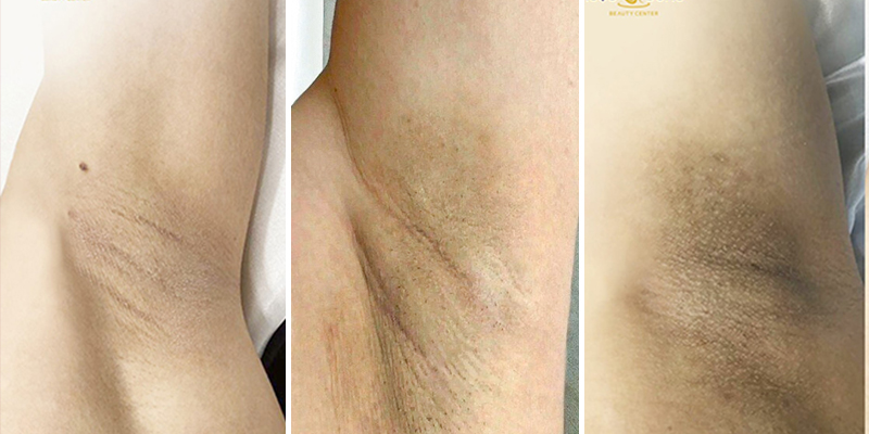 Cần xác định mức độ thâm nách trước khi trị thâm