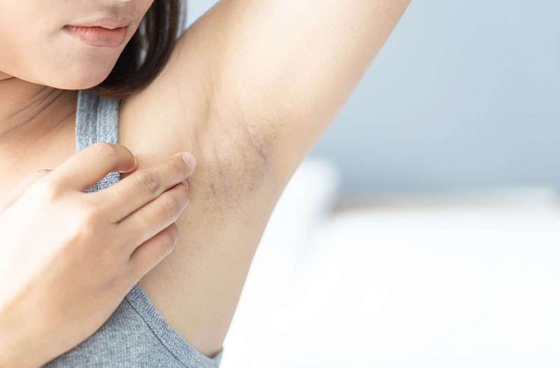 Cần điều trị sớm khi mới thâm nhẹ để tối ưu chi phí