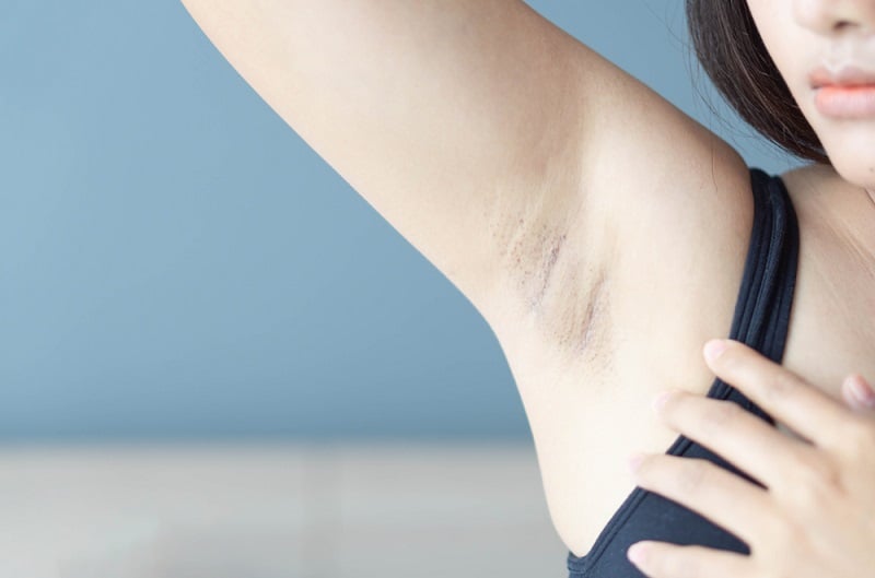 Cần đánh giá mức độ thâm nách trước khi xây dựng lộ trình điều trị phù hợp