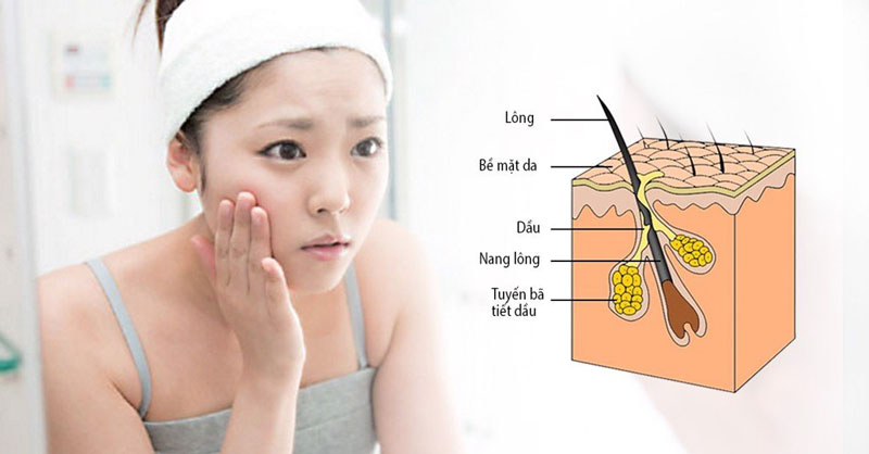 Nguyên nhân khiến da tiết nhiều dầu