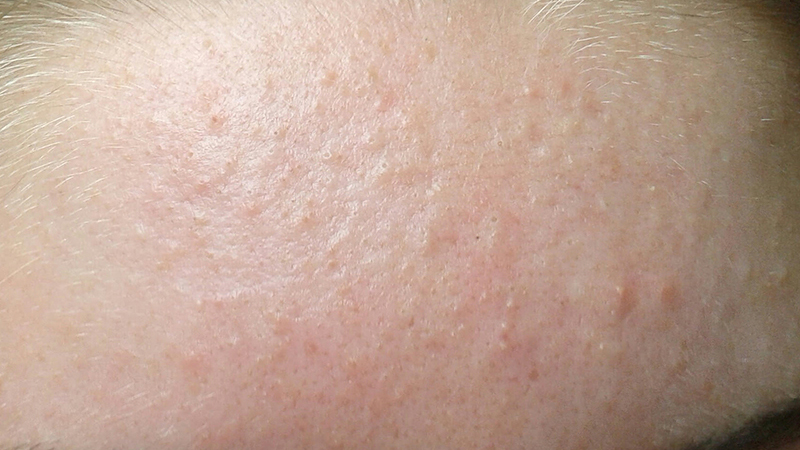 Da bị nổi mụn li ti do đâu?