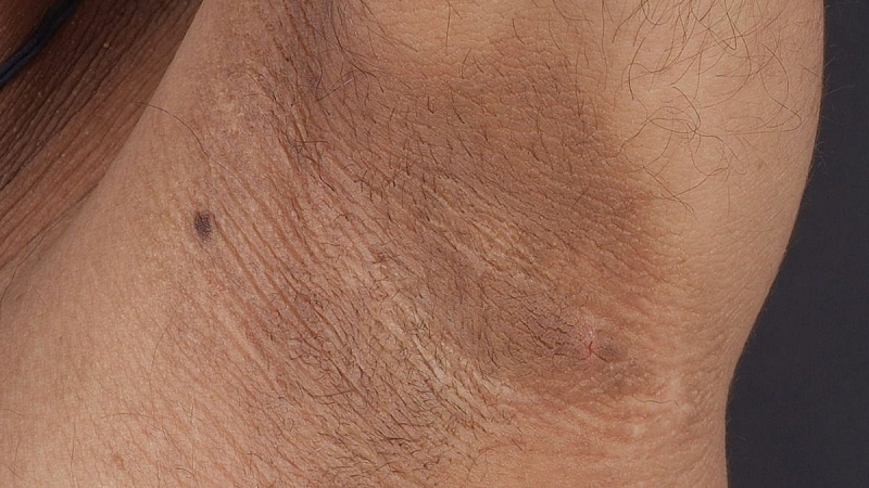 Không làm sạch kỹ vùng da dưới cánh tay  khiến vi khuẩn và tế bào chết tích tụ